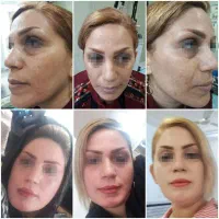 لیزر co2تک جلسه ای،تزریق چربی ودیگر خدمات زیبایی