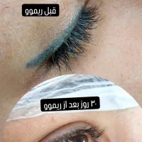 ریموو و پاک کردن تضمینی تتوی ابرو و چشم شما