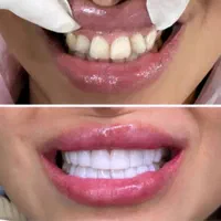 افر تابستانه کامپوزیت دندان متریال در جه یک .|خدمات آرایشگری و زیبایی|کرج, گلشهر|دیوار