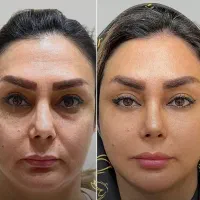 مدل رایگان آراف جوانساز مدل پاکسازی فقط هزینه مواد