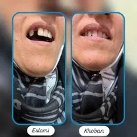 خدمات تخصصی پروتز متحرک(دندان مصنوعی)