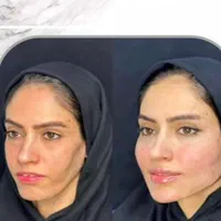 لیفت BAU فیس لیفت صورت اصلاح افتادگی لاغری صورت|خدمات آرایشگری و زیبایی|مشهد, هفت تیر (حافظ)|دیوار