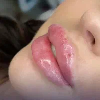 تخفیف ژل لب و بوتاکس فیلر مزو دکتر کاظمی