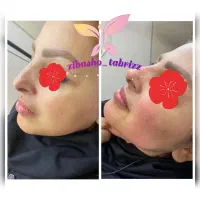 آموزش تزریق ژل بوتاکس مزو نخ ودیگر لاین های زیبایی|خدمات آموزشی|تبریز, |دیوار