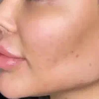 انجام خدمات تزریق فیلر و بوتاکس