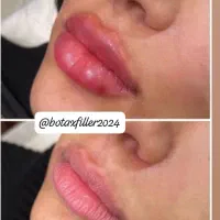 آموزش و خدمات تخصصی فیلر وبوتاکس|خدمات آموزشی|شیراز, معالیآباد|دیوار