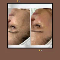 جشنواره تخفیف فیشال و مزونیدلینگ و پلاژن تراپی