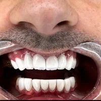 دندان کامپوزیت دندانپزشکی باهوش مصنوعی|خدمات آرایشگری و زیبایی|مشهد, دانشجو|دیوار