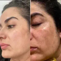 حذف خال گوشتی.خال.کک و مک.