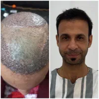 کاشت مو یا معجزه.خط رویش طبیعی تراکم بالا تضمینی|خدمات آرایشگری و زیبایی|یزد, |دیوار