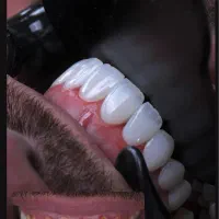 دندانپزشکی/لمینت/کامپوزیت/ایمپلنت