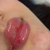 آموزش و تزریق تخصصی و تزریق ژل و بوتاکس محمدی