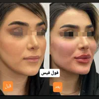 جشنواره/فیلر/بوتاکس/آنزیم/تخفیف دکترفیروزی|خدمات آرایشگری و زیبایی|شیراز, زرهی|دیوار