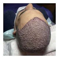 کاشت مو تبریزقیمت مناسب اقساطی فول تراکم|خدمات آرایشگری و زیبایی|صوفیان, |دیوار