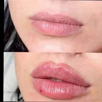 تزریق ژل لب ب روش روسی آنباکسش توسط زیباجو|خدمات آرایشگری و زیبایی|مشهد, پنجتن|دیوار