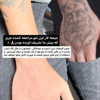 کربن تراپی لیزر کیوسوئیچ بستن منافذ|خدمات آرایشگری و زیبایی|دهدشت, |دیوار