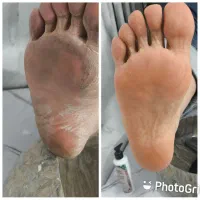 پدیکوروکفسابی برای ترک پا خشکی پاتیرگی