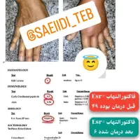 رماتیسم،نقرس ،ارتریت روماتوئید|آرایشی، بهداشتی، درمانی|بندر انزلی, گیلار|دیوار