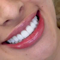 جشنواره ایمپلنت ، کامپوزیت و بلیچینگ (نقد و اقساط)