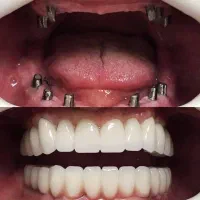 ایمپلنت دندان ، اقساطی ، شرایط ویژه ، با ضمانت