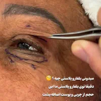 بلفاروپلاستی تخفیف ویژه ساکشن غبغب سوپرکانتورینگ|خدمات آرایشگری و زیبایی|اهواز, کیان اباد|دیوار