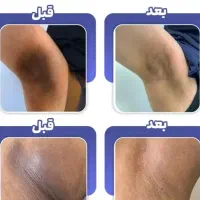 روشن سازی زیر بغل و نقاط حساس تضمینی