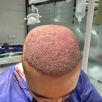 کاشت مو و ابرو با شرایط اقساطی به روش Micro FUE