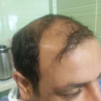 کاشت مو|خدمات آرایشگری و زیبایی|شیراز, قصرالدشت|دیوار
