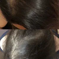 درمان ریزش مو