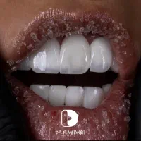 کامپوزیت دندان.لمینت|خدمات آرایشگری و زیبایی|مشهد, کوثر|دیوار