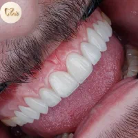 عصب کشی ترمیم کامپوزیت|خدمات آرایشگری و زیبایی|قم, نوقطار|دیوار