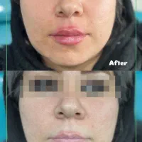 کانتورینگ فول فیس ، بوتاکس،لیزر ، ژل وفیلر ،فیشال|خدمات آرایشگری و زیبایی|فردیس, شهرک ۱۱۰|دیوار