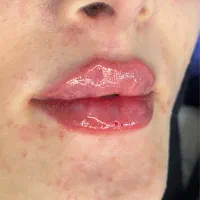 تخفیف فیلر صورت با ۱۱۰۰