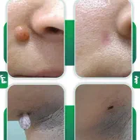 حذف خال، کک و مک و زوائد پوستی با کمترین قیمت