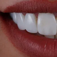ارائه خدمات کامپوزیت ولمینیت دندان (ونیرکامپوزیت )|خدمات آرایشگری و زیبایی|کرج, مهرویلا جنوبی|دیوار