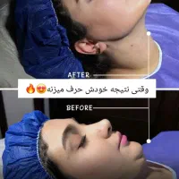 آف 50% ساکشن غبغب سوپر کانتور VLine بدون عمل جراحی|خدمات آرایشگری و زیبایی|مشهد, هفت تیر (آب و برق)|دیوار