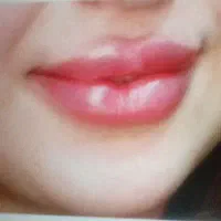 جشنواره بوتاکس فیلرلب ولیزرموی زائد