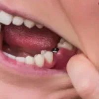 مرکزفوق تخصصی ایمپلنت دیجیتال/یکروزه/سبک کاخ لبخند