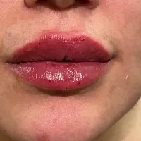 ژل و فیلرلب گونه زاویه فک کانتور نخ لیفت بوتاکس