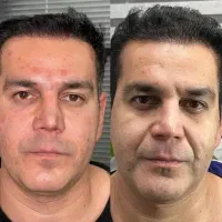 تخفیف هایفو کلینیک ژل بوتاکس۶۹۰ نخ