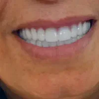 ساخت دندان مصنوعی / با قیمت بسیار مناسب