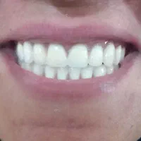 دندانسازی ، دندان مصنوعی ، دندانسازی