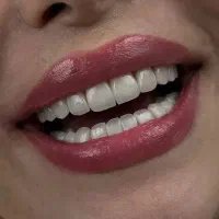 اقساط بدون چک / لمینت ایمپلنت کامپوزیت دندانپزشکی|خدمات زیبایی و سلامت|مشهد, کوثر|دیوار