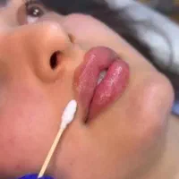 تزریق ژل و بوتاکس و مزو