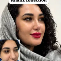 عمل بینی/پلک/غبغب/بوتاکس/پیکرتراشی|خدمات آرایشگری و زیبایی|یاسوج, |دیوار