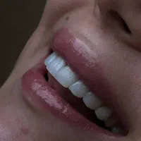 کامپوزیت یک‌روزه  ایمپلنت اقساطی ویانا