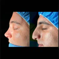 لیپوابدو مامورینو عمل زیبایی تخفیف استثنائی