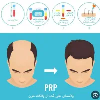 مرکز پی ارپی prp و مزوتراپی.پی ار پی