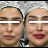 ژل .بوتاکس.مزو.PRP.تمامی جراحی های محدود