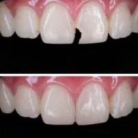 عصب کشی و ترمیم فقط 2م